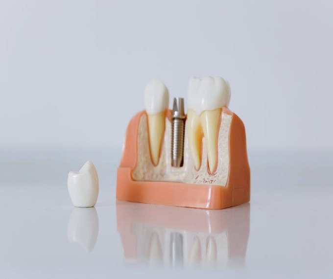 impianto dentale senza osso
