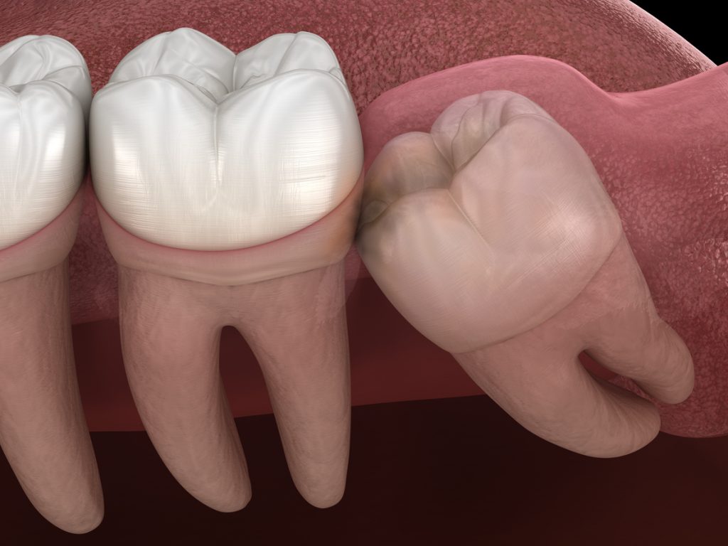 Dente del giudizio Incluso
