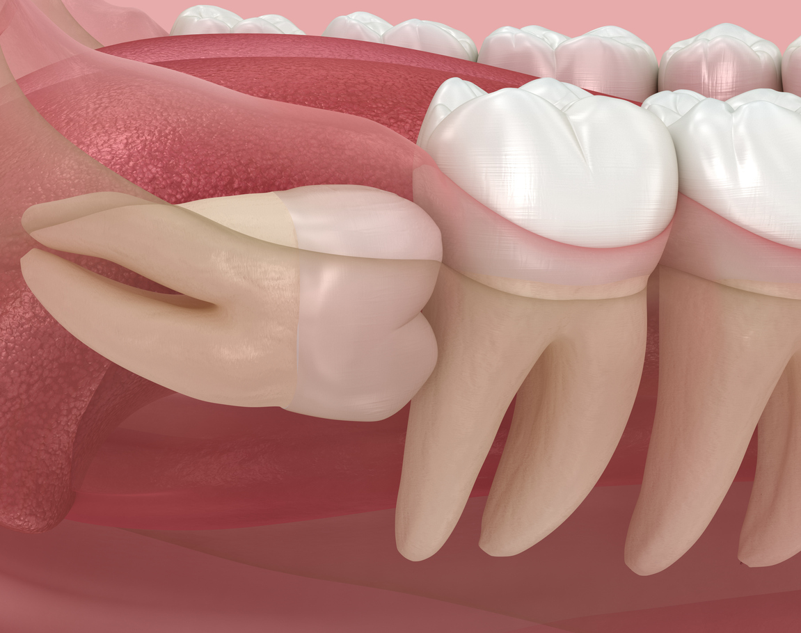 Dente del giudizio sdraiato
