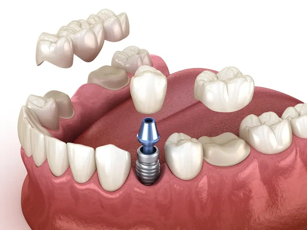 esempio di protesi fissa su denti naturali e su impianti